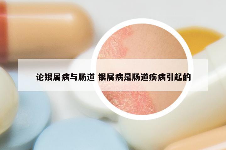 论银屑病与肠道 银屑病是肠道疾病引起的