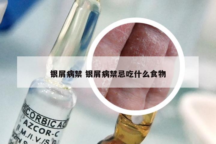 银屑病禁 银屑病禁忌吃什么食物