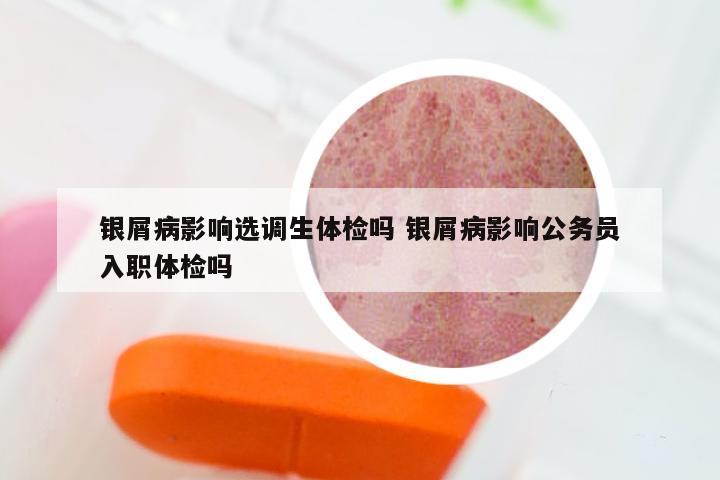银屑病影响选调生体检吗 银屑病影响公务员入职体检吗