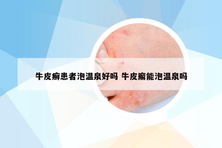 牛皮癣患者泡温泉好吗 牛皮廨能泡温泉吗