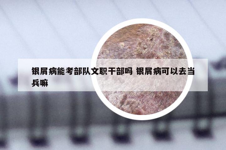 银屑病能考部队文职干部吗 银屑病可以去当兵嘛