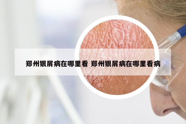 郑州银屑病在哪里看 郑州银屑病在哪里看病