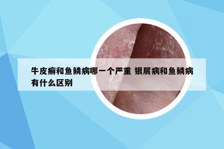 牛皮癣和鱼鳞病哪一个严重 银屑病和鱼鳞病有什么区别
