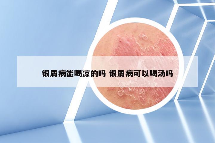 银屑病能喝凉的吗 银屑病可以喝汤吗
