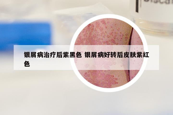 银屑病治疗后紫黑色 银屑病好转后皮肤紫红色