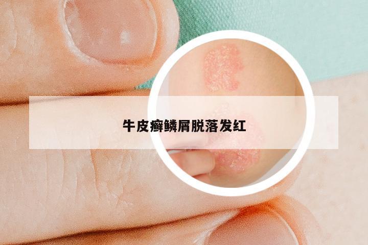 牛皮癣鳞屑脱落发红