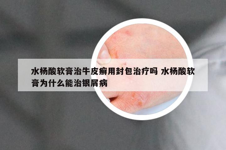 水杨酸软膏治牛皮癣用封包治疗吗 水杨酸软膏为什么能治银屑病