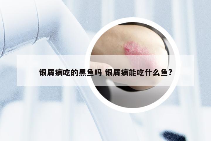 银屑病吃的黑鱼吗 银屑病能吃什么鱼?