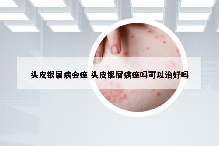 头皮银屑病会痒 头皮银屑病痒吗可以治好吗