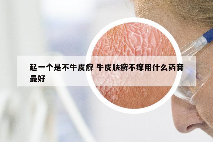 起一个是不牛皮癣 牛皮肤癣不痒用什么药膏最好
