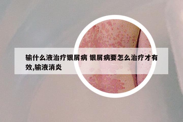 输什么液治疗银屑病 银屑病要怎么治疗才有效,输液消炎