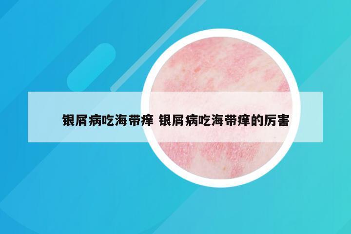 银屑病吃海带痒 银屑病吃海带痒的厉害