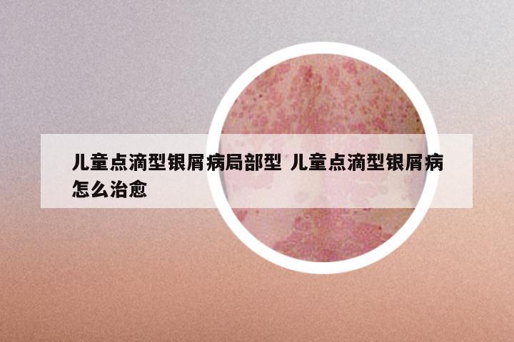 儿童点滴型银屑病局部型 儿童点滴型银屑病怎么治愈