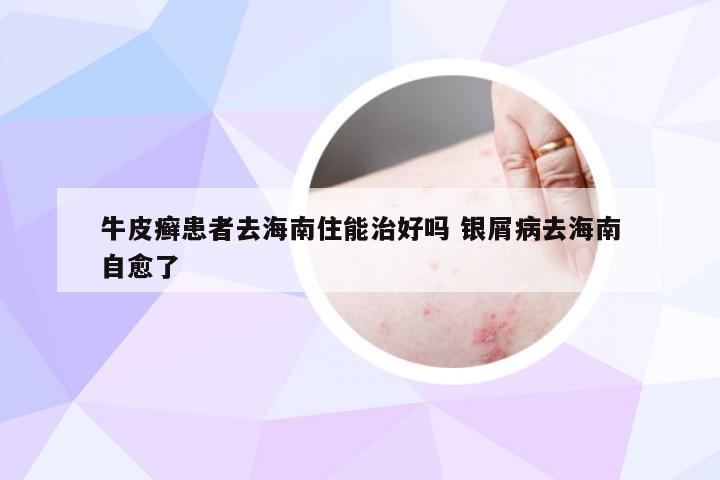牛皮癣患者去海南住能治好吗 银屑病去海南自愈了