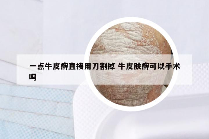 一点牛皮癣直接用刀割掉 牛皮肤癣可以手术吗