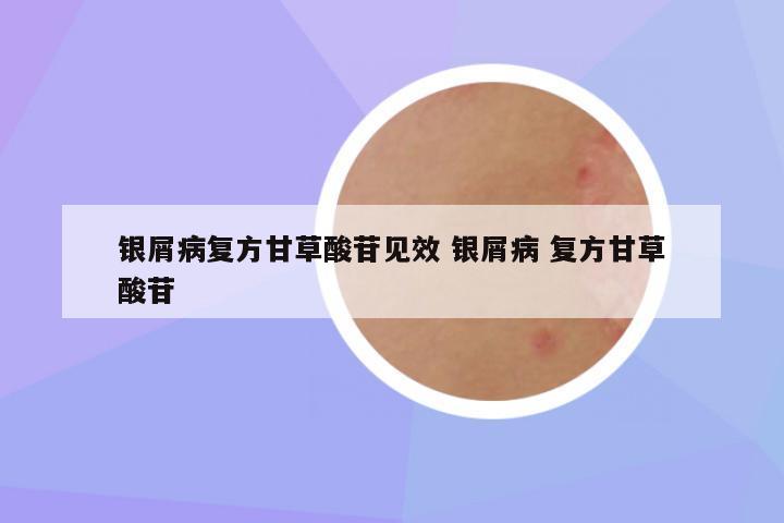 银屑病复方甘草酸苷见效 银屑病 复方甘草酸苷