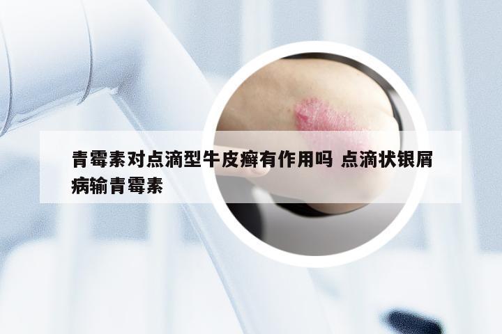 青霉素对点滴型牛皮癣有作用吗 点滴状银屑病输青霉素