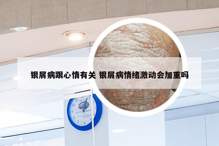银屑病跟心情有关 银屑病情绪激动会加重吗