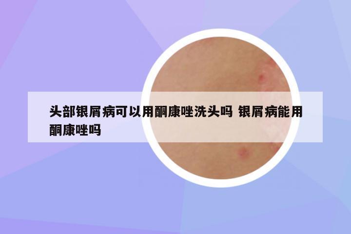 头部银屑病可以用酮康唑洗头吗 银屑病能用酮康唑吗