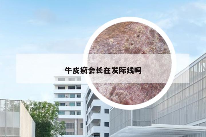牛皮癣会长在发际线吗
