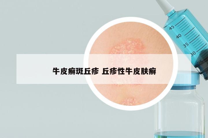 牛皮癣斑丘疹 丘疹性牛皮肤癣