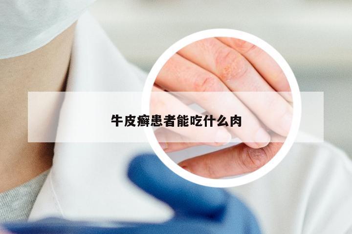 牛皮癣患者能吃什么肉