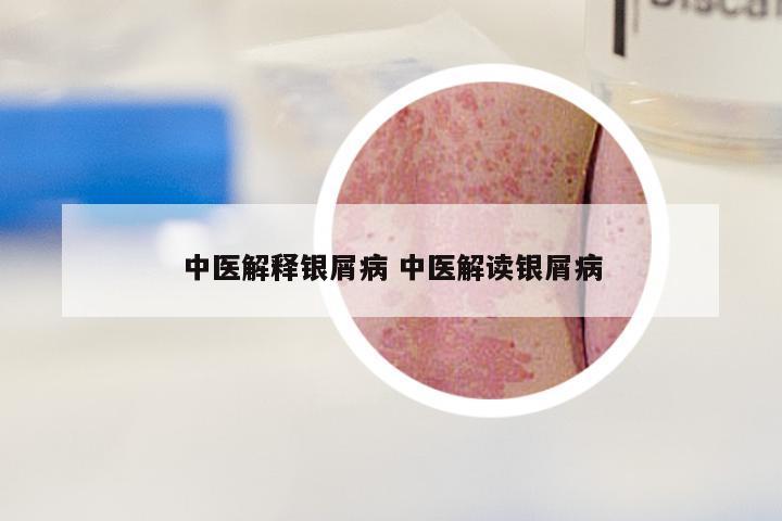 中医解释银屑病 中医解读银屑病