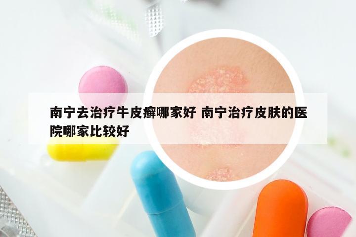 南宁去治疗牛皮癣哪家好 南宁治疗皮肤的医院哪家比较好