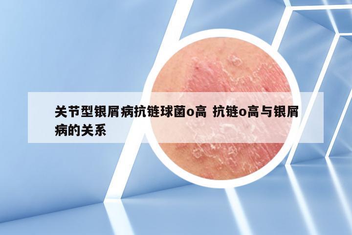 关节型银屑病抗链球菌o高 抗链o高与银屑病的关系