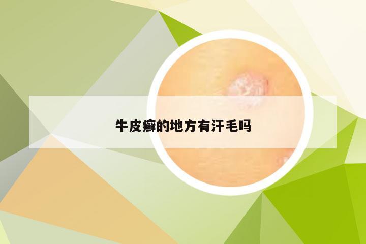 牛皮癣的地方有汗毛吗