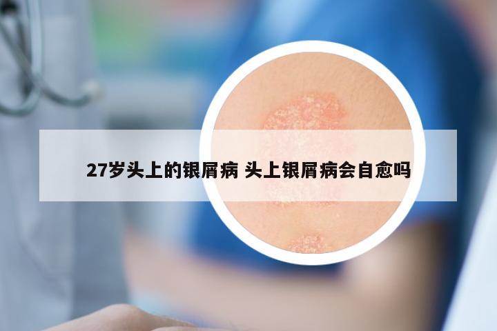 27岁头上的银屑病 头上银屑病会自愈吗