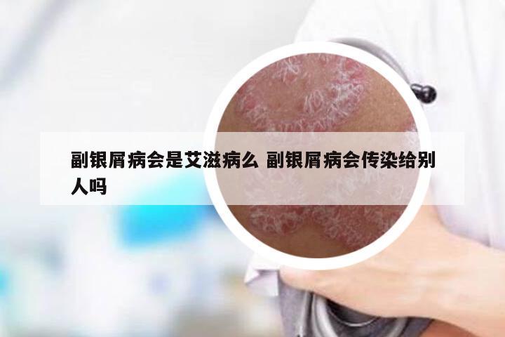 副银屑病会是艾滋病么 副银屑病会传染给别人吗