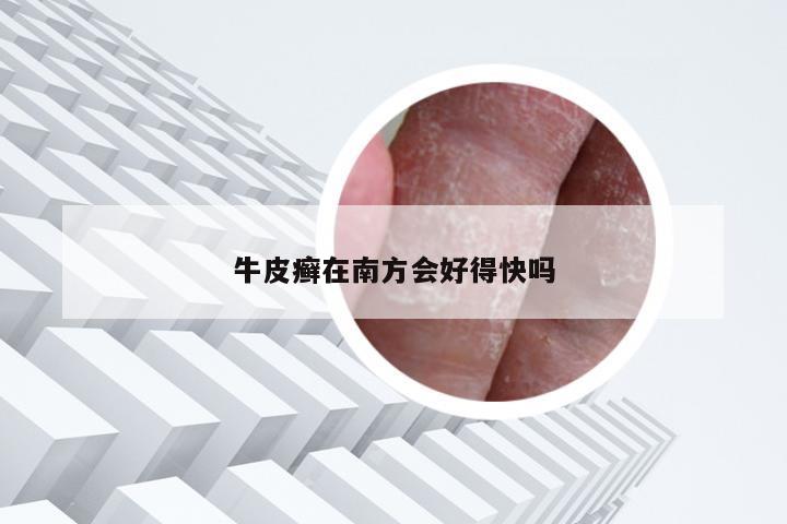 牛皮癣在南方会好得快吗