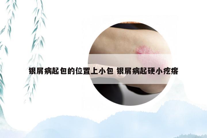 银屑病起包的位置上小包 银屑病起硬小疙瘩