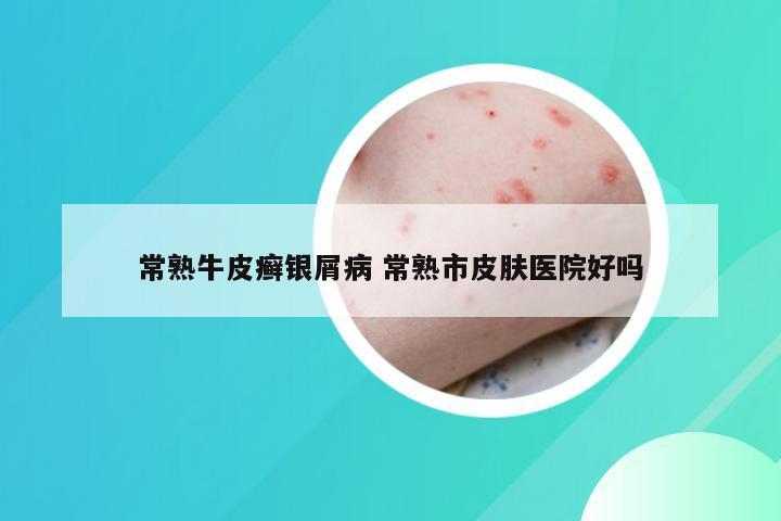常熟牛皮癣银屑病 常熟市皮肤医院好吗