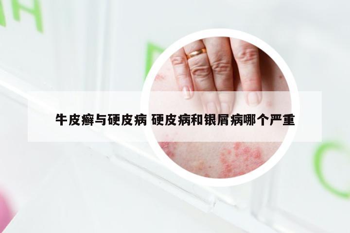 牛皮癣与硬皮病 硬皮病和银屑病哪个严重