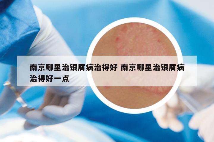 南京哪里治银屑病治得好 南京哪里治银屑病治得好一点