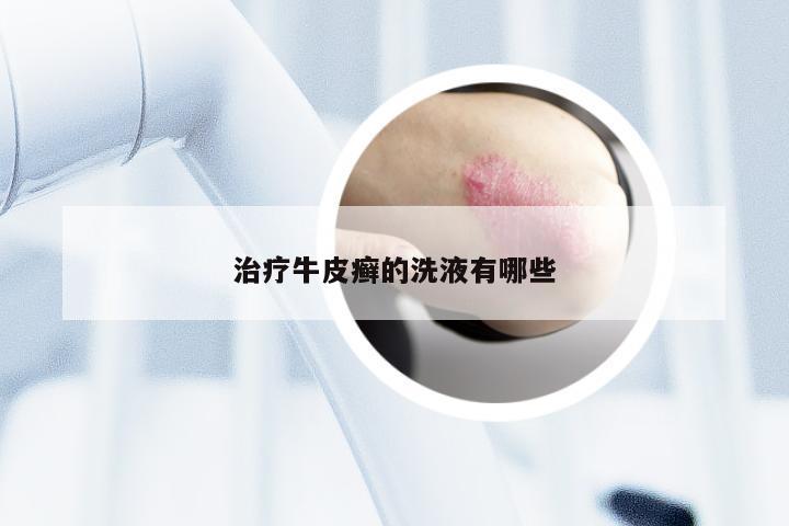 治疗牛皮癣的洗液有哪些