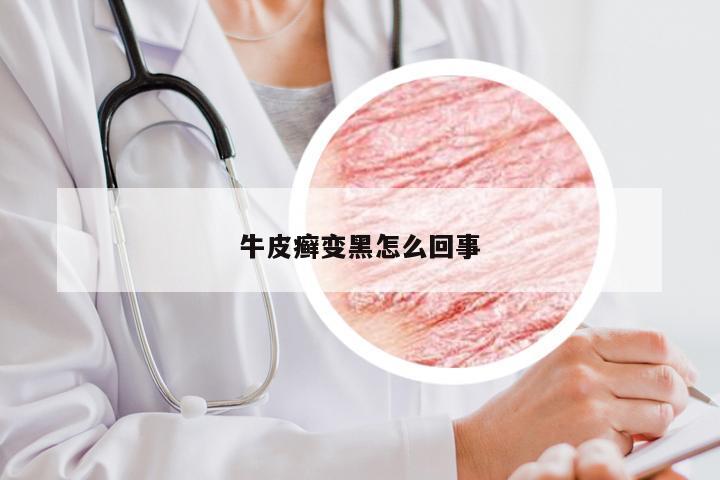 牛皮癣变黑怎么回事