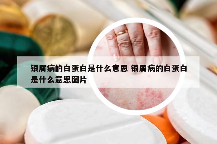 银屑病的白蛋白是什么意思 银屑病的白蛋白是什么意思图片