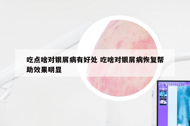 吃点啥对银屑病有好处 吃啥对银屑病恢复帮助效果明显