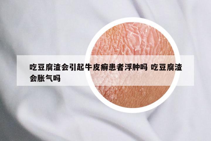 吃豆腐渣会引起牛皮癣患者浮肿吗 吃豆腐渣会胀气吗