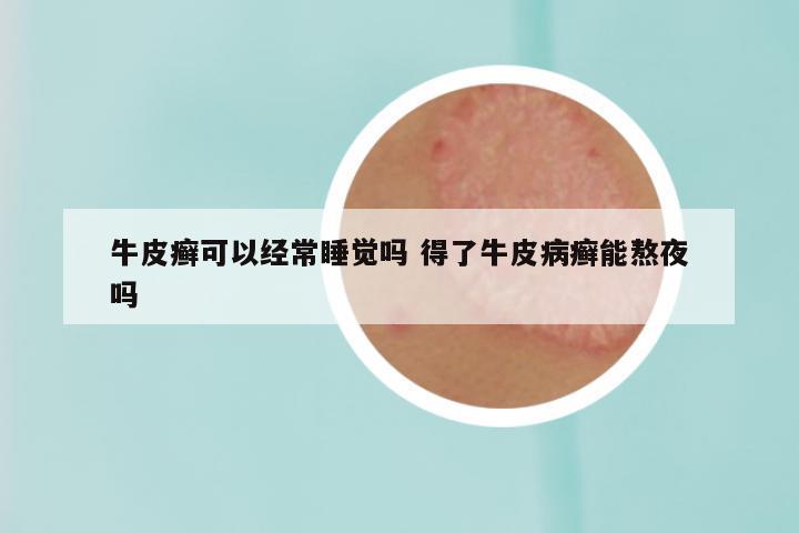 牛皮癣可以经常睡觉吗 得了牛皮病癣能熬夜吗