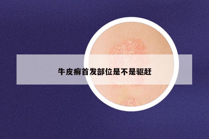 牛皮癣首发部位是不是驱赶