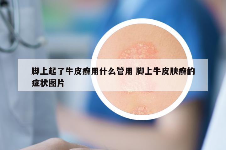 脚上起了牛皮癣用什么管用 脚上牛皮肤癣的症状图片
