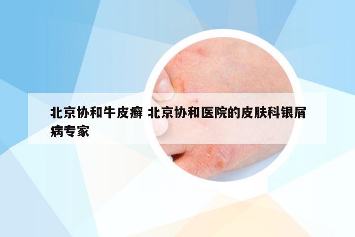 北京协和牛皮癣 北京协和医院的皮肤科银屑病专家