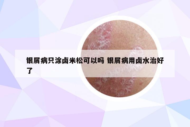 银屑病只涂卤米松可以吗 银屑病用卤水治好了