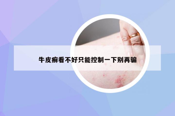 牛皮癣看不好只能控制一下别再骗