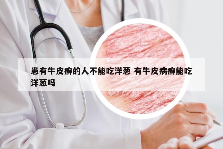 患有牛皮癣的人不能吃洋葱 有牛皮病癣能吃洋葱吗