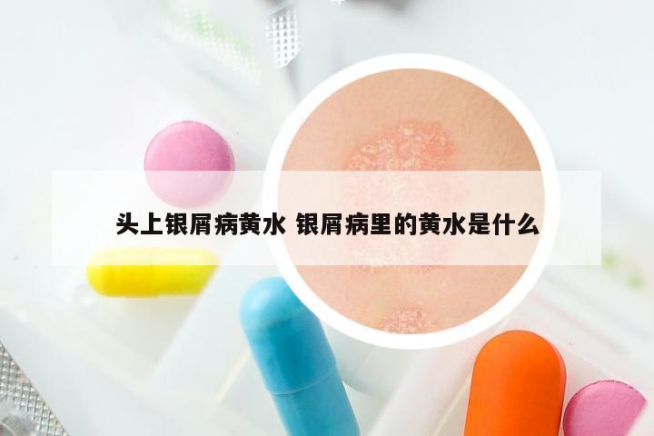头上银屑病黄水 银屑病里的黄水是什么
